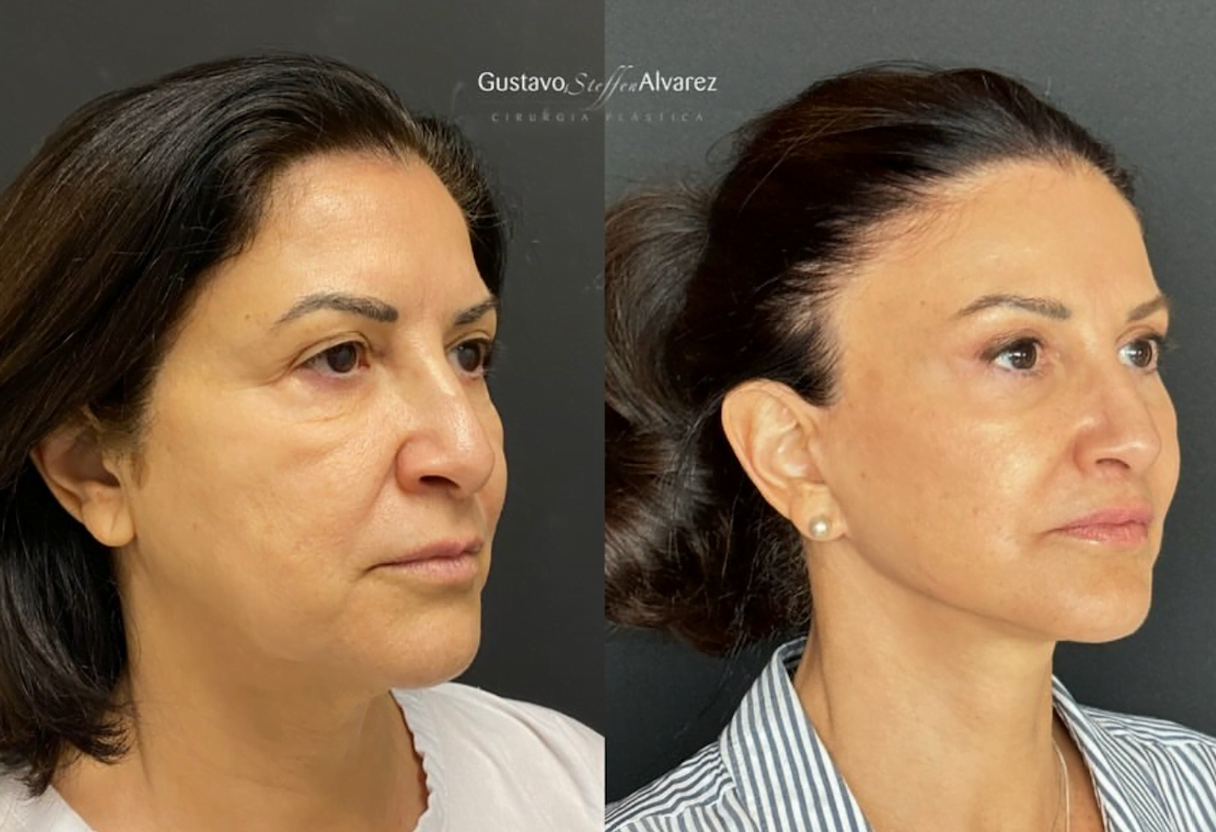 Foto de antes e depois lifting facial deep plane gustavo alvarez