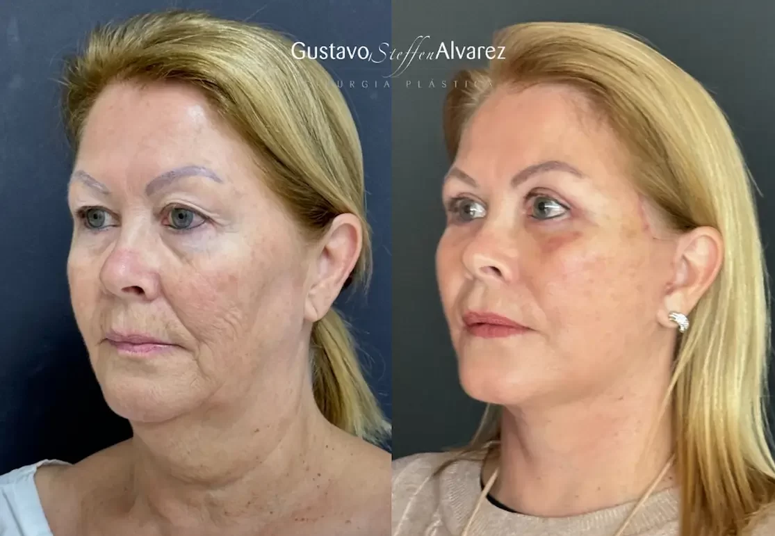 abertura lifting facial deep plane dr gustavo alvarez 1 e1717275092167